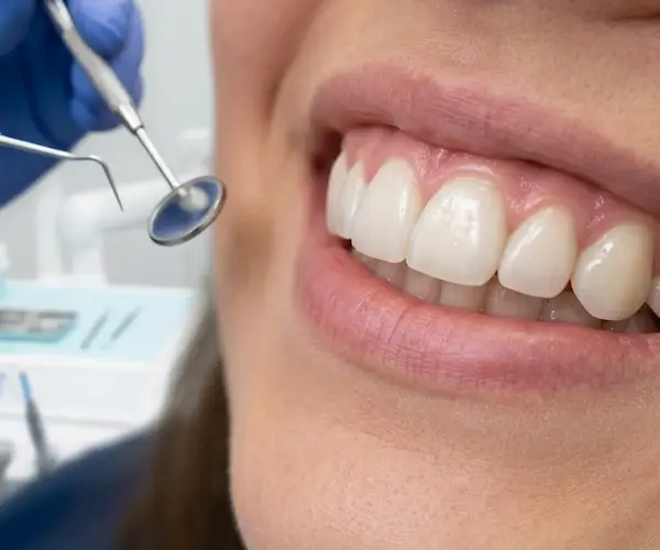 Composite Veneering